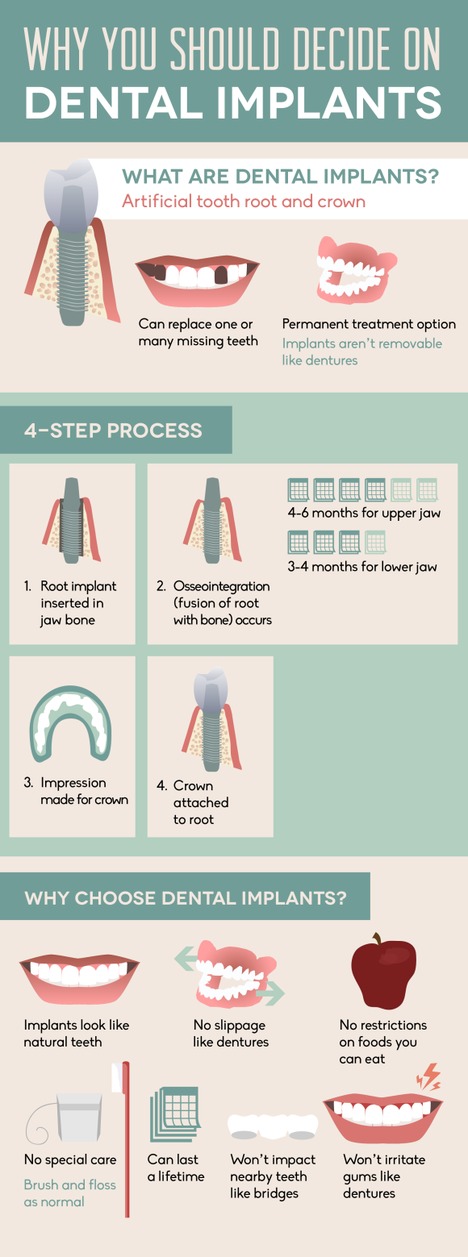 Why You Should Decide on Dental Implants
